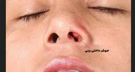 جوش داخل بینی، چه زمانی خطرناک می شود؟