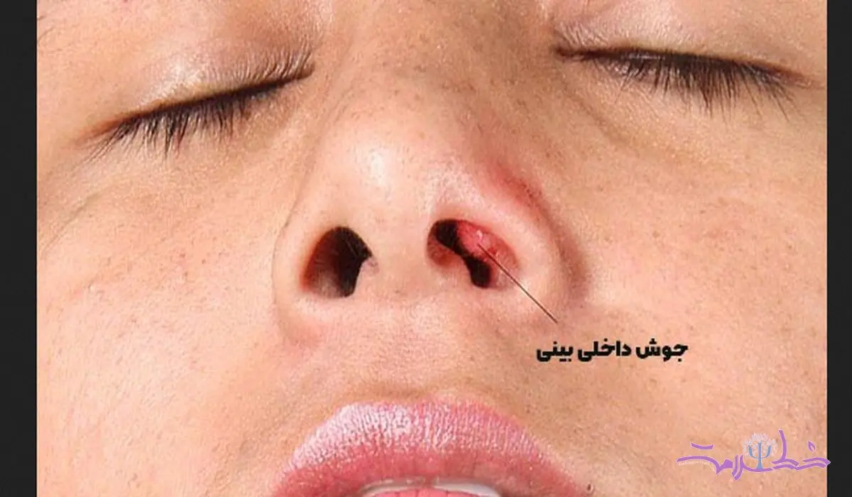 جوش داخل بینی، چه زمانی خطرناک می شود؟