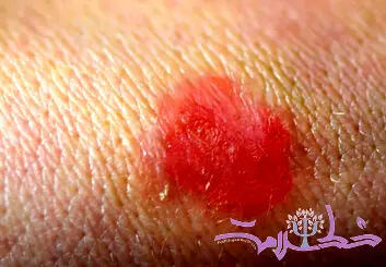 قارچ تناسلی TMVII چیست و چگونه از طریق رابطه جنسی منتقل می‌شود؟