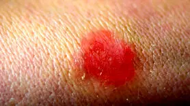 قارچ تناسلی TMVII چیست و چگونه از طریق رابطه جنسی منتقل می‌شود؟