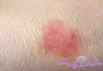 قارچ تناسلی TMVII چیست و چگونه از طریق رابطه جنسی منتقل می‌شود؟