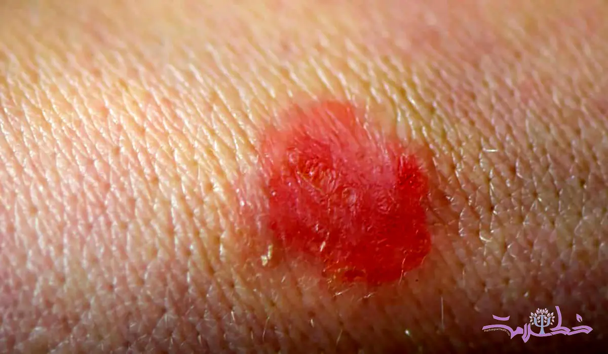 قارچ تناسلی TMVII چیست و چگونه از طریق رابطه جنسی منتقل می‌شود؟