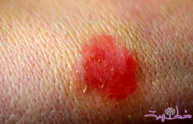 قارچ تناسلی TMVII چیست و چگونه از طریق رابطه جنسی منتقل می‌شود؟