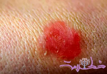 قارچ تناسلی TMVII چیست و چگونه از طریق رابطه جنسی منتقل می‌شود؟