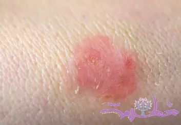 قارچ تناسلی TMVII چیست و چگونه از طریق رابطه جنسی منتقل می‌شود؟