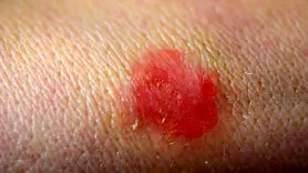 قارچ تناسلی TMVII چیست و چگونه از طریق رابطه جنسی منتقل می‌شود؟