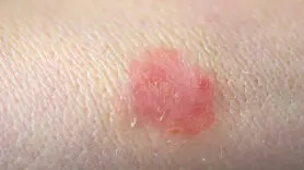 قارچ تناسلی TMVII چیست و چگونه از طریق رابطه جنسی منتقل می‌شود؟