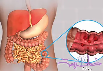 چرا در بدن پولیپ تشکیل می شود؟+ علائم و علل و تشخیص