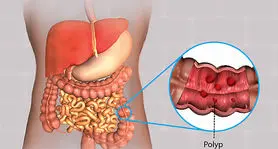 چرا در بدن پولیپ تشکیل می شود؟+ علائم و علل و تشخیص