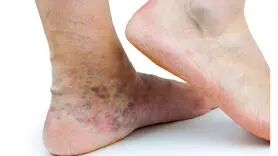 فیلم/ روش تهیه داروی درمان خانگی واریس