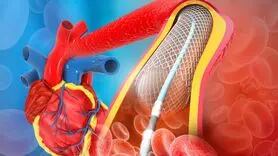 آنژیوپلاستی چیست و چگونه انجام می شود؟