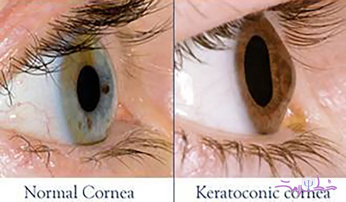  جدیدترین روش‌ درمان قوز قرنیه + در قوز قرنیه چه اتفاقی برای چشم می افتد؟