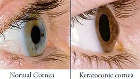  جدیدترین روش‌ درمان قوز قرنیه + در قوز قرنیه چه اتفاقی برای چشم می افتد؟