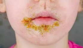 گیاهان دارویی موثر برای درمان بیماری زرد زخم 