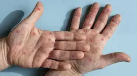 آبله میمونی تهدیدی جدی است 