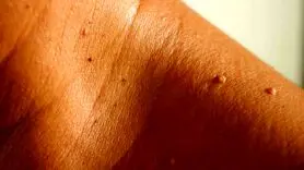 منگوله پوستی چیست و چه تفاوتی با زگیل تناسلی دارد؟