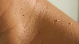منگوله پوستی چیست و چه تفاوتی با زگیل تناسلی دارد؟