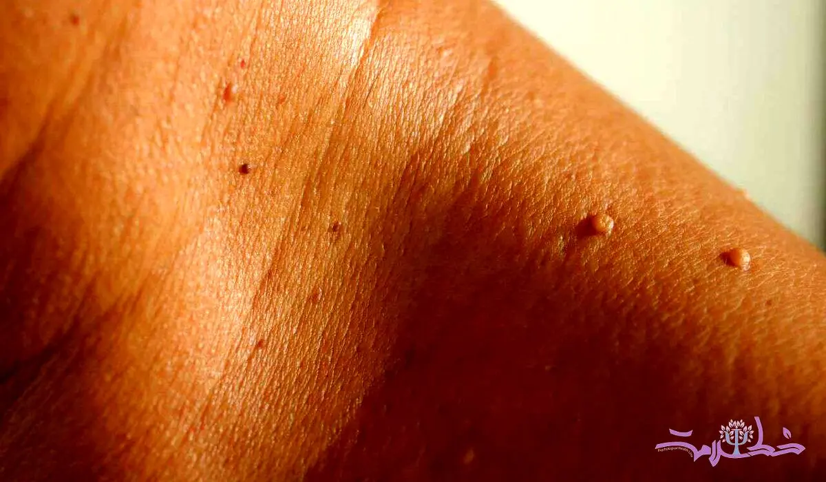 منگوله پوستی چیست و چه تفاوتی با زگیل تناسلی دارد؟