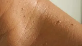 منگوله پوستی چیست و چه تفاوتی با زگیل تناسلی دارد؟