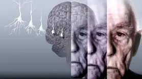 علائم اولیه آلزایمر از دهان و دندان شروع می شود !