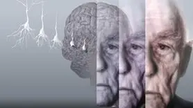علائم اولیه آلزایمر از دهان و دندان شروع می شود !
