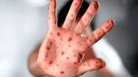 سازمان جهانی بهداشت اولین آزمایش تشخیصی آبله میمونی را تایید کرد