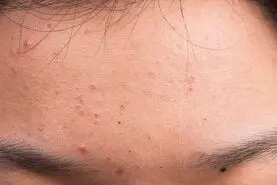 علت و نحوه‌ی درمان جوش پیشانی 