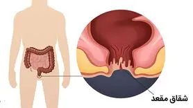 شقاق مقعد چیست؟ + تکنیک های ساده و کاربردی برای درمان